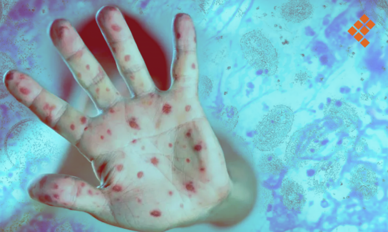 Descartan casos de viruela símica en Hidalgo